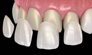 Animated smile during veneers placement